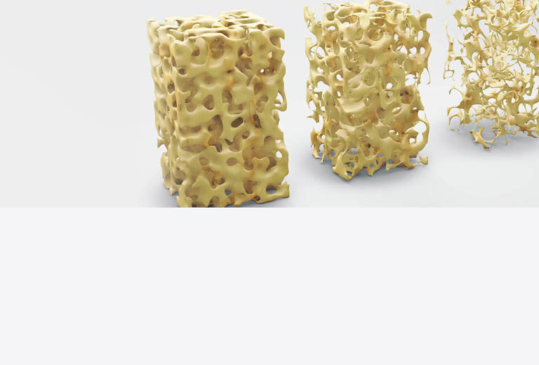 Osteoporose