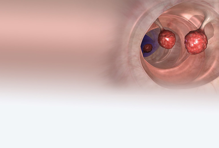 Darmkrebsfrüherkennung