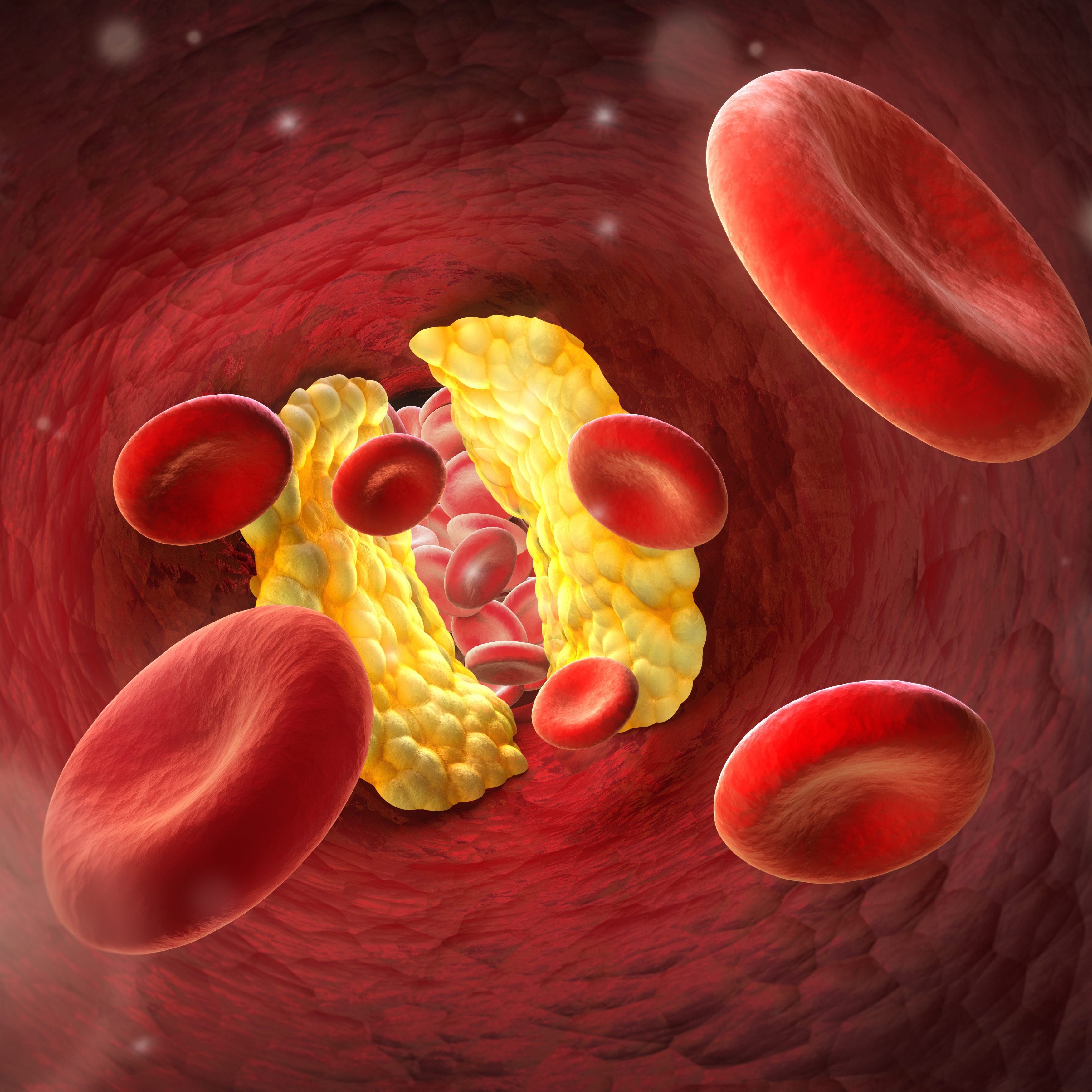 Adobestock 73649000 Arteriosklerose Quadr